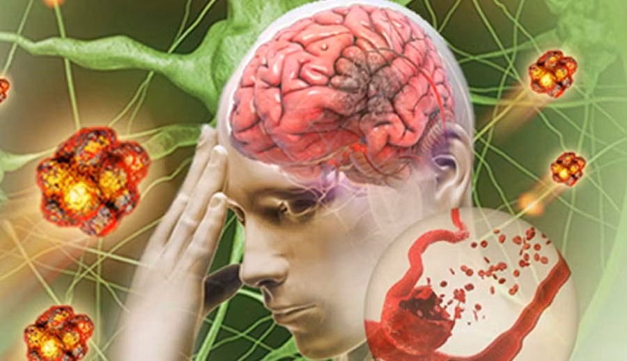 Nhồi máu não là bệnh lý mạch máu não có thời gian điều trị dài, nguy cơ cao và tỷ lệ tử vong cao. Theo các điều tra, nghiên cứu, nhồi máu não dễ xảy ra ở người trung niên và người già khoảng trên dưới 60 tuổi. (Ảnh minh họa)