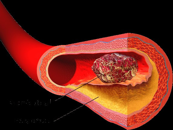Đây cũng là bệnh toàn thân, khi bị tắc lên não có thể gây đột quỵ do thiếu máu cục bộ, khi bị tắc ở tim có thể gây đột tử. Vậy làm thế nào để có thể phát hiện trước cục máu đông? Chúng ta có thể để ý xem cơ thể có 3 biểu hiện sau vào buổi sáng hay không.