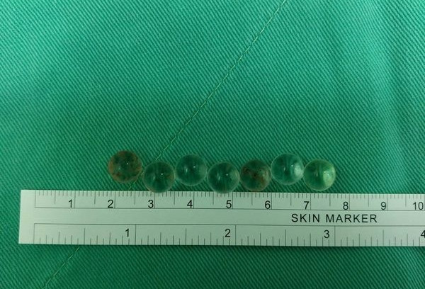 Không còn cách nào khác, chàng trai đành đến bệnh viện xin giúp đỡ. Theo lời người này, mới đầu khi vùng kín chấn thương, hạ bộ của anh chi mẩn đỏ nhỏ, ngủ một giấc dậy đã thấy sưng tấy cực to nên vội vàng đi khám chữa.