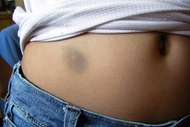 Trên cơ thể xuất hiện những vết bầm tím không rõ nguyên nhân, hãy coi chừng có thể mắc các bệnh về gan nhé! Cách đây không lâu, hai bệnh nhân ở Bình Đông, Đài Loan (Trung Quốc) đi khám do đau bụng và cũng có vết bầm tím quanh rốn không rõ nguyên nhân. (Ảnh minh họa)