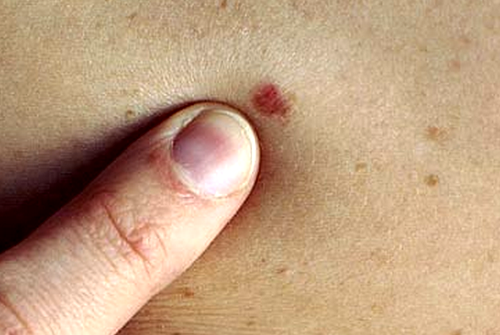 Dau hieu not ruoi canh bao gan va mat dang keu cuu