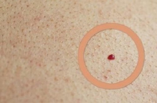 Dau hieu not ruoi canh bao gan va mat dang keu cuu-Hinh-2