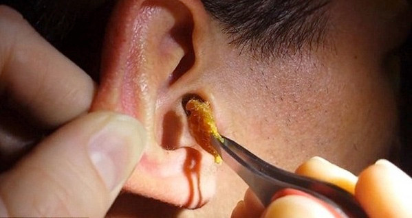 Ráy tai có thể được chia thành ráy tai khô và ráy tai ướt. Nếu mọi người thấy tai khó chịu, cảm thấy bức bí âm ỉ giống như có dị vật mắc kẹt trong tai hay bị ù tai, suy giảm thính lực, đau hoặc nghi ngờ viêm tai giữa thì cần phải đến bệnh viện, nhờ bác sĩ thăm khám và làm sạch. Nếu tai ngoài bị viêm, cũng có thể yêu cầu bác sĩ lấy ráy tai luôn.