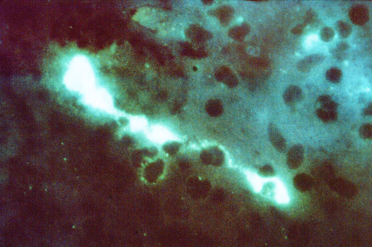 Tìm ra nguyên nhân, đội ngũ y bác sĩ lập tức điều chỉnh phương án điều trị cho cô Cảnh. Sau khi được tiêm doxycycline kết hợp tiêm moxifloxacin để chống nhiễm trùng, thân nhiệt của bệnh nhân nhanh chóng trở lại bình thường, triệu chứng tức ngực và khó thở được cải thiện rõ rệt.