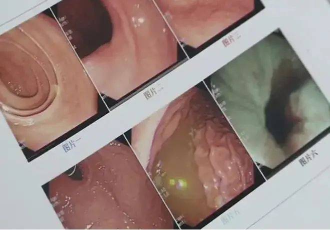 Quá sợ hãi, cô gái quyết định đến bệnh viện để nội soi dạ dày, kết quả phát hiện cô bị viêm loét dạ dày nghiêm trọng dẫn đến xuất huyết dạ dày. Tại sao lại như vậy? Ăn hạt dẻ thực sự sẽ khiến dạ dày xuất huyết, có đúng hay không?