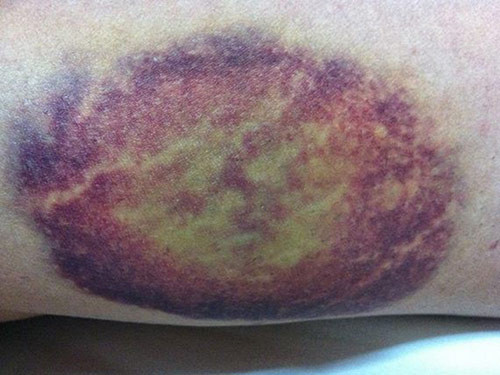 Chính vì thế, nếu cảm thấy cơ thể thường xuất hiện những vết bầm tím không phải do va đập, không phải do tổn thương ngoài da, bạn nhất định phải đi khám ngay trước khi quá muộn.