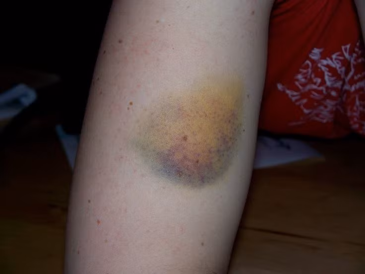 Bác sĩ Tiêu Đôn Nhân - Khoa tiêu hoá gan mật cũng giải thích rằng, khi chúng ta còn trong bụng mẹ, rốn là nơi nối dây rốn với cơ thể, sau này nó trở thành một dây chằng tròn, nằm trong khoang bụng. Giả dụ chảy máu cạnh dây chằng tròn sẽ lan dọc ra bên ngoài, máu chảy ra ngoài dẫn đến máu ứ nhiều cạnh rốn.