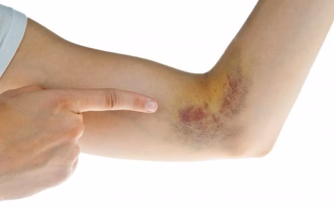 Thế nhưng sau khi kiểm tra máu, siêu âm và chụp cắt lớp vi tính, bác sĩ phát hiện cả hai bệnh nhân đã bị ung thư gan ở giai đoạn cuối và giai đoạn giữa. Đặc biệt, các khối u gan có dấu hiệu vỡ.