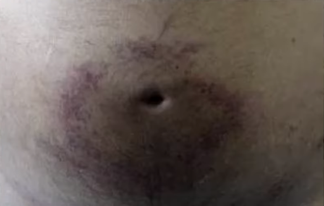 Trong trường hợp hai bệnh nhân này, do khối u gan bị vỡ và chảy máu nên máu bầm tím quanh rốn. Thế nhưng thực tế, chảy máu do bệnh gan không chỉ xảy ra ở rốn.