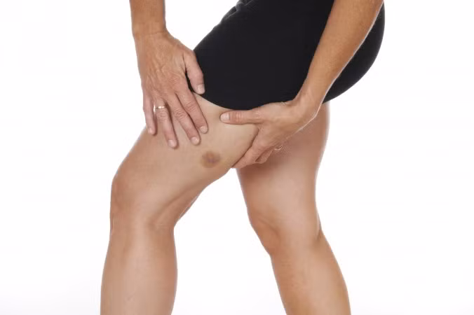 Hai bệnh nhân được đưa vào bệnh viện Bình Đông đều nhập viện do đau bụng, đặc biệt nhất là họ có những vết bầm tím không rõ nguyên nhân quanh rốn. Đây được cho là triệu chứng điển hình của viêm tụy cấp xuất huyết hoặc chảy máu trong ổ bụng.