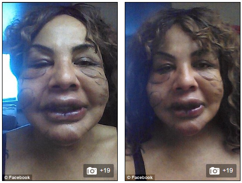 Cô phải chịu nhiều đau đớn khi gỡ bỏ các cục xi măng trên mặt.