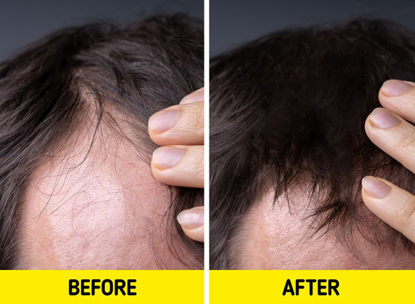 Giảm rụng tóc. Chuyên gia sức khỏe tin rằng, chà các móng vào nhau sẽ cải thiện tình trạng tóc rụng sau 3-6 tháng.