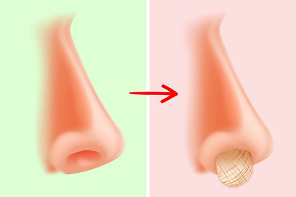 Dễ gây chảy máu cam. Niêm mạc mũi khá mỏng, mềm và chứa nhiều mạch máu. Dùng tay ngoáy mũi với lực tác động mạnh, lớp niêm mạc có thể bị rách dẫn đến chảy máu cam nguy hiểm.