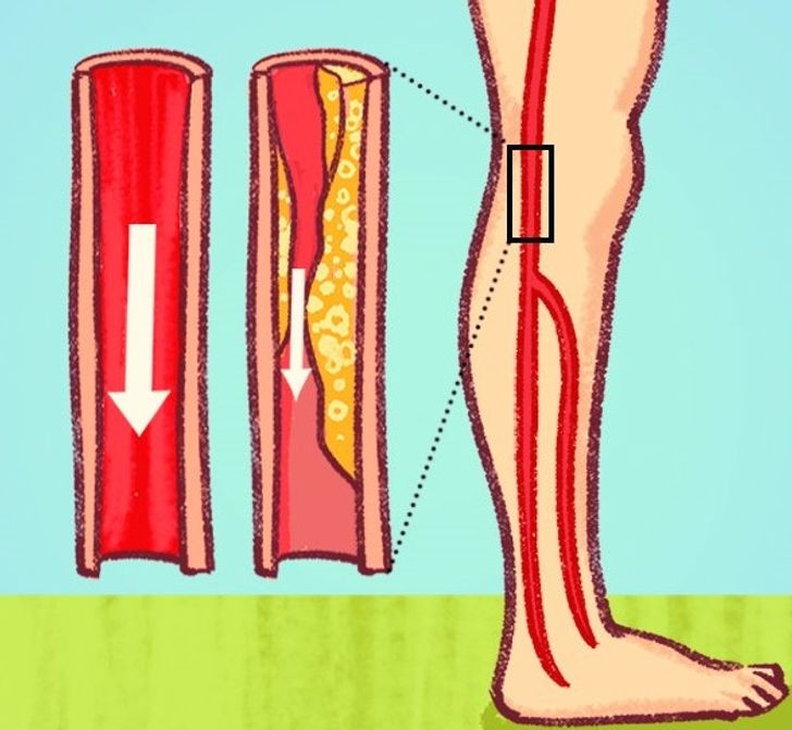 7 dấu hiệu tắc động mạch người trẻ cũng dễ mắc - Hình 4 7 dau hieu tac dong mach nguoi tre cung de mac-Hinh-4