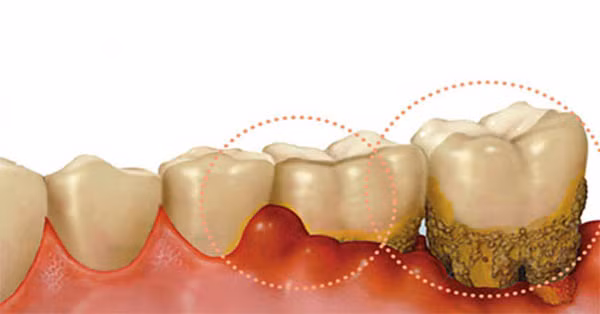 Theo các nhà khoa học, khi vi khuẩn trong miệng sử dụng cặn thức ăn để phát triển và sinh sôi, nó sẽ tạo ra các chất có mùi như hydrogen sulfide và methyl mercaptan.