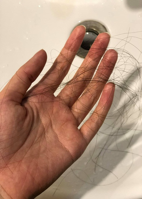 Diễm My bị rụng tóc, lông mày khi hóa trị. Cô cũng thức trắng đêm vì không nằm được.