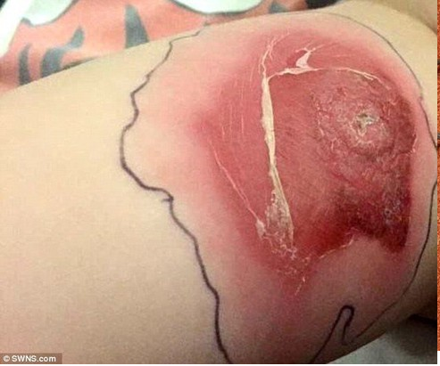 Tiếp đó, vết thương lớn xung quanh vết cắn xuất hiện do các tế bào bị phá hủy. Khi nọc độc đi vào máu, mạch máu sẽ bị phá vỡ, gây chảy máu trong khiến các cơ quan nội tạng bị phá hủy khủng khiếp. Ảnh minh họa.