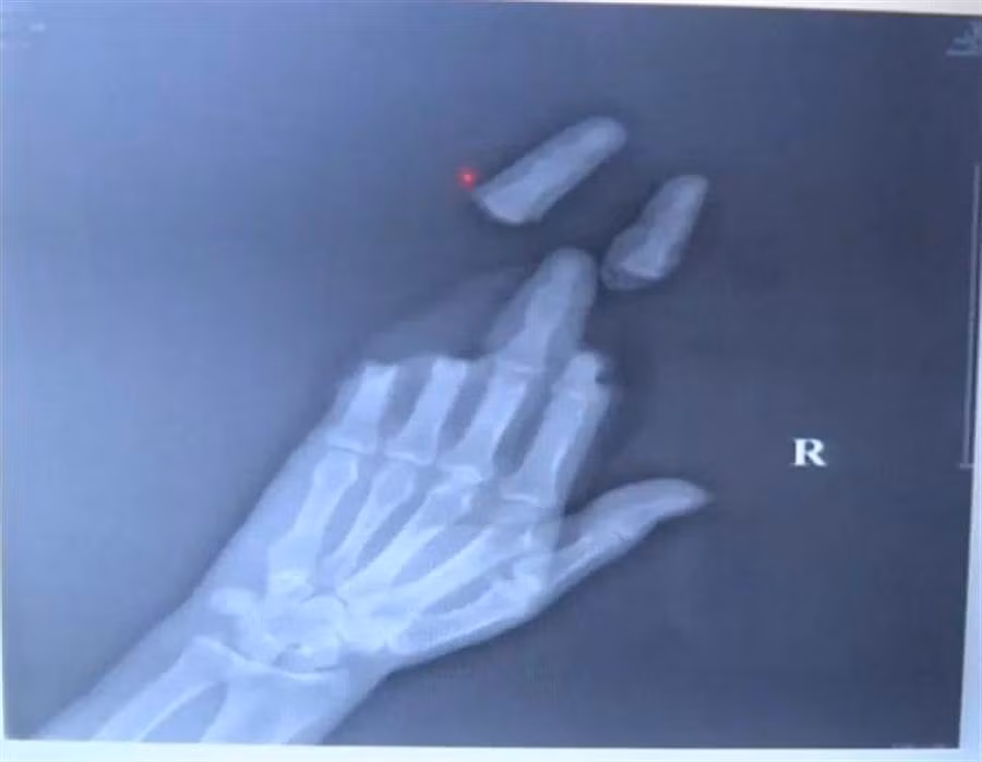 Thả diều ngày gió lớn, người đàn ông gặp chuyện khó tin Tha dieu ngay gio lon, nguoi dan ong gap chuyen kho tin