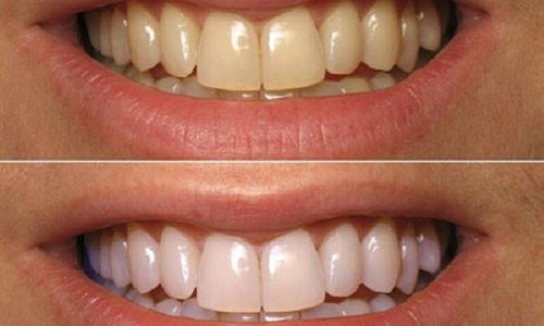 Rang trang nhanh nhu su voi meo don gian bang baking soda