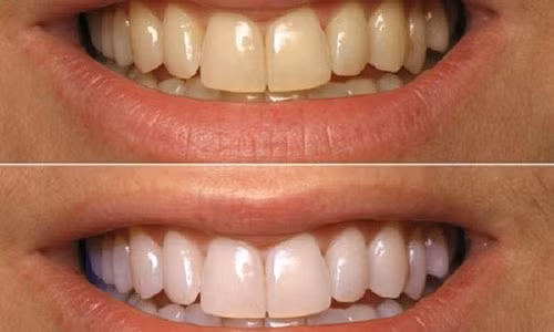 Rang trang nhanh nhu su voi meo don gian bang baking soda