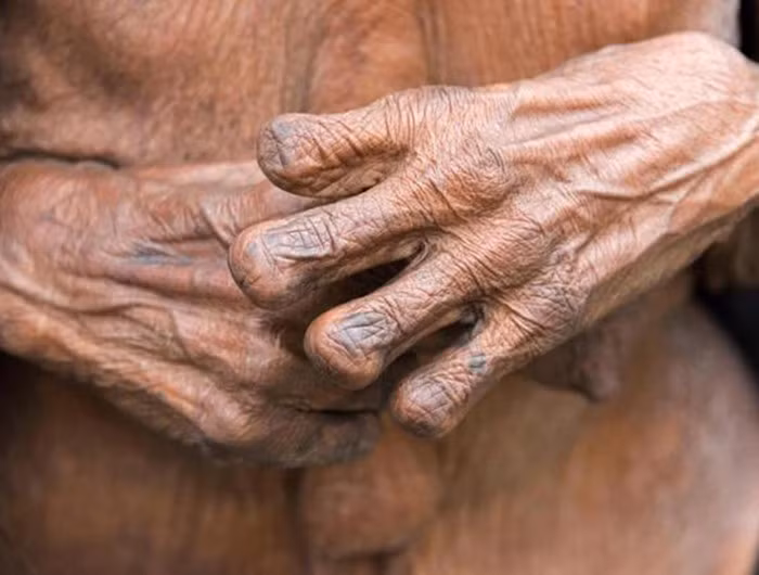 Họ cho rằng, việc cắt đầu ngón tay sẽ khiến cho linh hồn của người quá cố được ra đi thanh thản, theo đó, các em bé cũng bị người mẹ cắt đầu ngón tay.