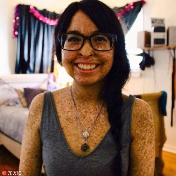 Cô Andrea Monroy, 23 tuổi, mắc phải một căn bệnh về da hiếm gặp, đó là cực kỳ nhạy cảm với ánh sáng mặt trời, tiếp xúc quá nhiều với ánh nắng có thể dẫn đến ung thư. Khi còn nhỏ, cơ thể Andrea đã có những tàn nhang bất thường. Lúc 5 tuổi, cô được chẩn đoán bệnh khô sắc tố da. Để bảo vệ làn da của Andrea, gia đình cô phải sử dụng cửa sổ màu và cho cô con gái học trong nhà. Andrea chỉ có thể đi ra ngoài vào ban đêm. 