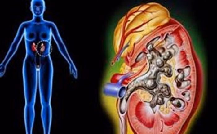 Chữa viêm thận cấp. Dùng 50g lô căn, 30g rau diếp cá, 30g rễ cỏ tranh sắc nước uống. Uống liên tục trong 1 tháng, mỗi ngày 3 lần. Nhớ là trong thời gian dùng bài thuốc này phải kiêng tuyệt đối muối. Ảnh: Suckhoe24h.