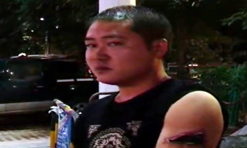 Anh Fu đến bệnh viện vì vết loét ngày càng nặng. Tại đây, các bác sỹ cho biết, do nhiễm trùng mà thịt đã bị hoại tử dần và nếu để lâu, nguy cơ phải cưa tay là rất cao. Bây giờ, anh Fu đang phải cố kiếm tiền điều trị vết loét đang hoại tử. Chỉ vì tiếc tiền không dùng laser mà bây giờ anh phải bỏ ra số tiền điều trị lên đến hàng trăm triệu.