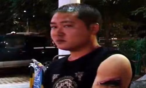 Anh Fu đến bệnh viện vì vết loét ngày càng nặng. Tại đây, các bác sỹ cho biết, do nhiễm trùng mà thịt đã bị hoại tử dần và nếu để lâu, nguy cơ phải cưa tay là rất cao. Bây giờ, anh Fu đang phải cố kiếm tiền điều trị vết loét đang hoại tử. Chỉ vì tiếc tiền không dùng laser mà bây giờ anh phải bỏ ra số tiền điều trị lên đến hàng trăm triệu.