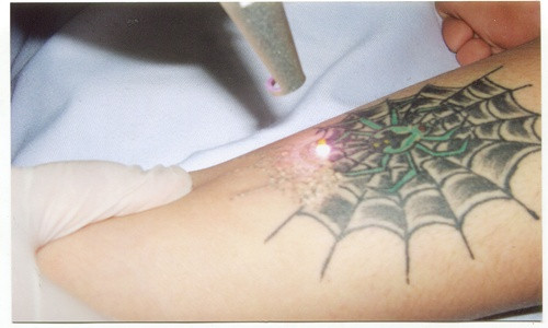 Nhân viên xăm hình cho biết, nếu như muốn xóa hình xăm thì bạn phải ngâm nó trong một loại chất lỏng, sau đó chà mực cho mờ dần hoặc cách tối ưu nhất là xóa xăm bằng laser.