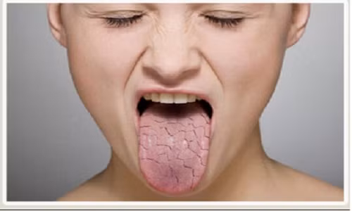 4. Trị chứng khô miệng Khi nhai hạt quả cau sẽ tạo ra một lượng nước bọt đáng kế, giúp bệnh nhân mắc chứng khô miệng cải thiện rất tốt và đồng thời giảm bệnh tiểu đường. (Ảnh: Nha khoa tổng quát)