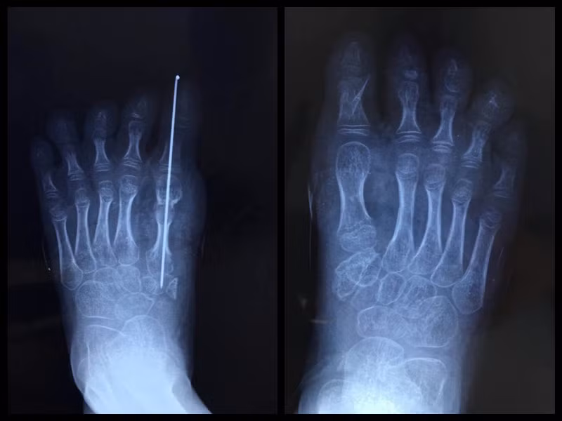 Sau 8, 9 giờ làm việc tỉ mỉ, cuộc phẫu thuật đã thành công tốt đẹp. Toàn bộ các ngón chân được lắp ghép hoàn chỉnh với đầy đủ các dây thần kinh. Vào buổi trưa ngày hôm sau, các ngón chân của bé gái đột nhiên tái nhợt rồi lại hồng hào, sau đó lại trắng bệch, cứ như vậy triệu chứng diễn ra đến tối.