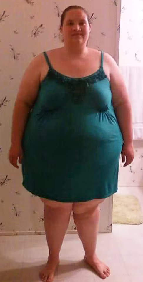 Cô Celia Shroder, 32 tuổi đến từ Colorado, Mỹ đã phải lựa chọn thực hiện phẫu thuật tạo hình bụng Tummy Tuck bởi sau khi trải qua thủ tục phẫu thuật dạ dày giảm cân, cơ thể cô trở nên bầy nhầy và không còn hình dáng.