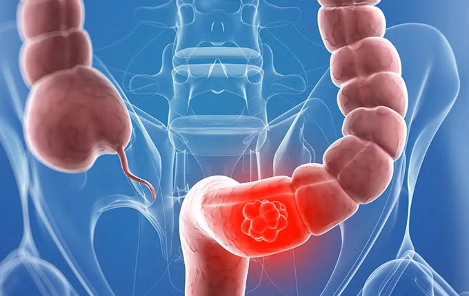 Viêm đại tràng là hiện tượng viêm, loét ở đại tràng khiến cho chức năng của đại tràng bị rối loạn gây nên rất nhiều triệu chứng phiền toái cho người trong cuộc sống. Ảnh: Cam thảo dược.