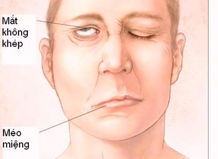 Trị trúng phong, tai biến mạch máu não. Bài thuốc gồm địa long, xuyên khung, đào nhân, hồng hoa, mỗi vị 4g; xích thược 6g, đương quy 8g, hoàng kỳ 15g. Ngày một thang, sắc uống chia 3 lần chỉ trong 3 ngày. Ảnh: Ancungnguuhoanghoan.