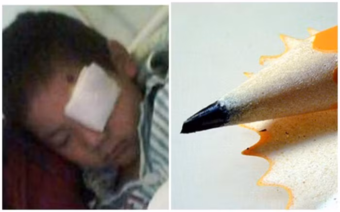 Tại Trung Quốc đầu tháng 2 vừa qua, một em bé 5 tuổi ngã xuống đất cũng đã bị một cây bút chì đâm sâu vào mắt trái, gần vị trí mũi và xuyên thẳng vào não của bé khiến bé suýt mù mắt. Ảnh: Sina.