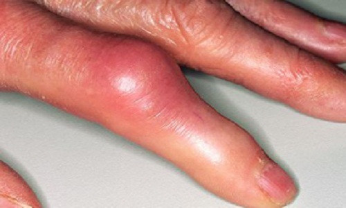 1. Tác dụng chống viêm. Một trong những lợi ích nổi tiếng nhất của việc sử dụng lá cây thường xuân, đó là khả năng chống lại các vấn đề viêm nhiễm trong cơ thể. Nếu bạn bị viêm khớp, bệnh gout, hay bệnh thấp khớp, bạn có thể dùng trà lá thường xuân hoặc bôi lá thường xuân trực tiếp lên chỗ viêm. 