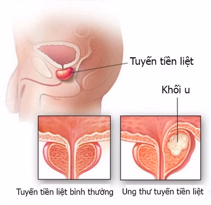 Lý giải cho nguyên nhân này, các bác sĩ cho rằng, cả hai bệnh ung thư tuyến tiền liệt và hói đầu ở nam giới có thể được gây ra bởi mức độ cao hơn của hormone giới tính nam - androgen - và thụ thể androgen. Ảnh: SKĐS.