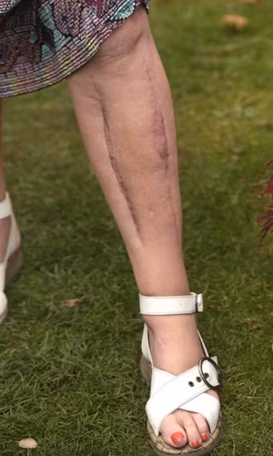 Chỉ vì tiếc chiếc quần jeans chật và muốn mảnh mai mà cô suýt đối mặt với tử thần. Sau ca phẫu thuật, chân cô Jane có những vết sẹo dài nhưng cô vẫn thầm cảm ơn trời vì mình sống sót. Ảnh: The Sun.