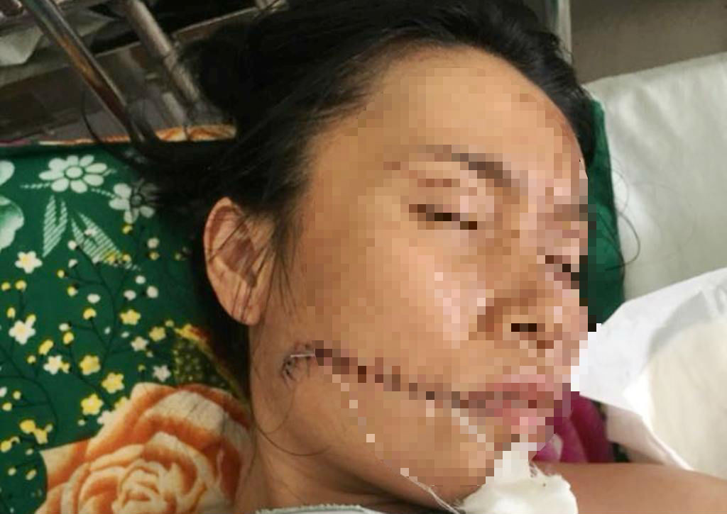 Chị M. đang điều trị vết thương ở mặt và nhiều vết bỏng khắp cơ thể. (Ảnh: Gia đình cung cấp).