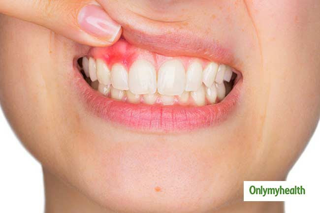 Chảy máu chân răng: Thiếu vitamin C có thể gây chảy máu chân răng và viêm sưng lợi. Nếu tình trạng này kéo dài và nghiêm trọng, bạn thậm chí có thể bị rụng răng.