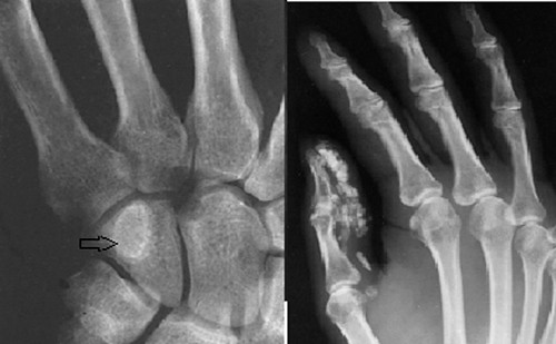 Bi benh u xuong sun co nguy hiem khong?