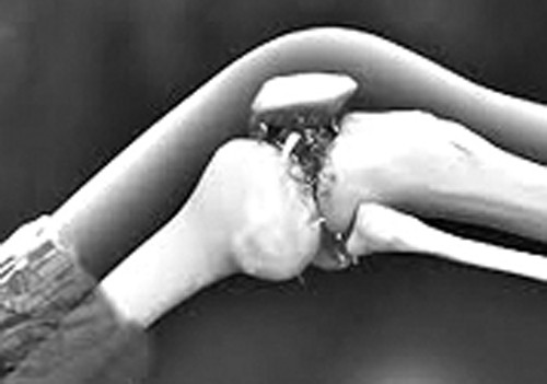 Dieu tri u mau trong cot song the nao?