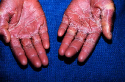 Nguy co mac phai hoi chung soc nhiem doc nguy hiem khi den “ngay den do