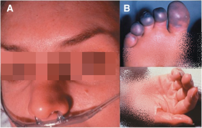 Nguy co mac phai hoi chung soc nhiem doc nguy hiem khi den “ngay den do