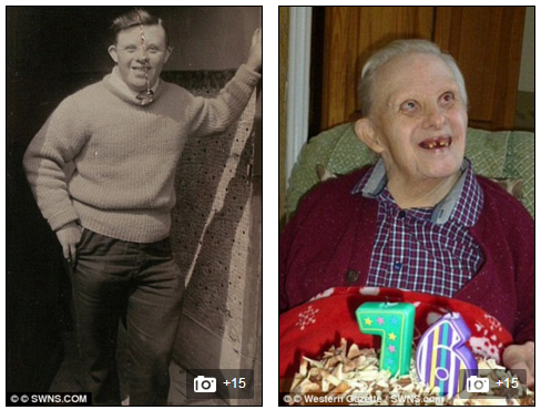 Một trường hợp mắc bệnh down khác ông Kenny Cridge được ghi vào sách kỷ lục Guiness là người mắc bệnh down già nhất thế giới vào năm 2008, khi ông 76 tuổi.