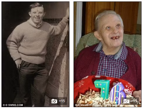 Một trường hợp mắc bệnh down khác ông Kenny Cridge được ghi vào sách kỷ lục Guiness là người mắc bệnh down già nhất thế giới vào năm 2008, khi ông 76 tuổi.