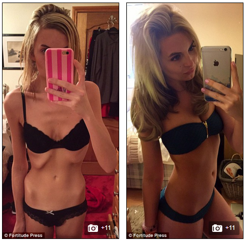 Cô thường xuyên chia sẻ ảnh về cách chữa trị bệnh biếng ăn cũng như sự thay đổi cơ thể trên mạng xã hội Instagram.