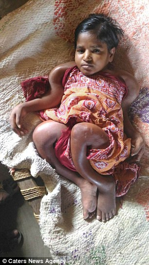 Bệnh Kunti gặp phải có tên là bệnh xương dễ gãy (OL). Đây là bệnh hiếm gặp gây ra bởi một gen đột biến ảnh hưởng đến việc sản xuất collagen khiến cho xương con và dễ gãy.