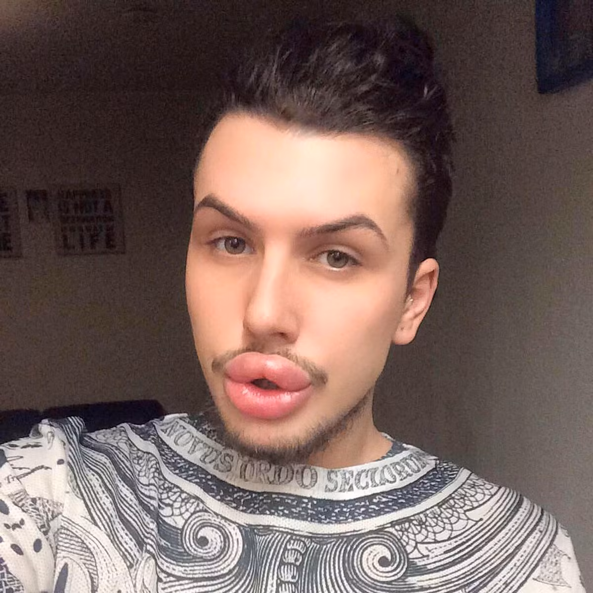 Tổng cộng, James đã phẫu thuật hơn 50 lần để có bờ môi căng mọng như cô Kim siêu vòng 3.